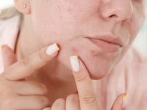 Acne Treatment Delhi