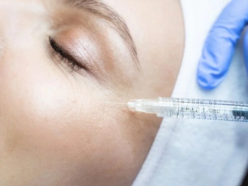 fillers treatment delhi