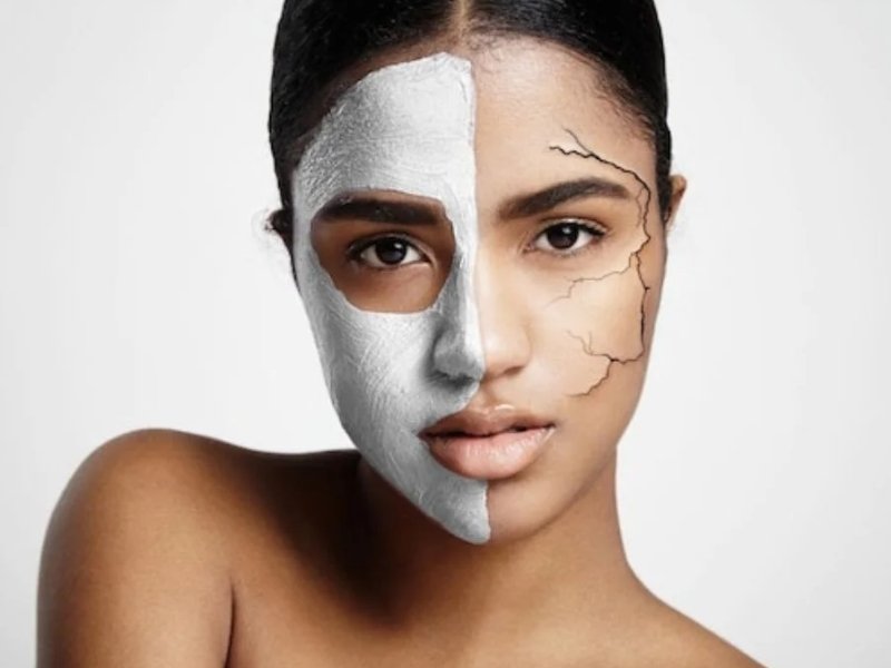 Photofacial for Pigmentation in Delhi