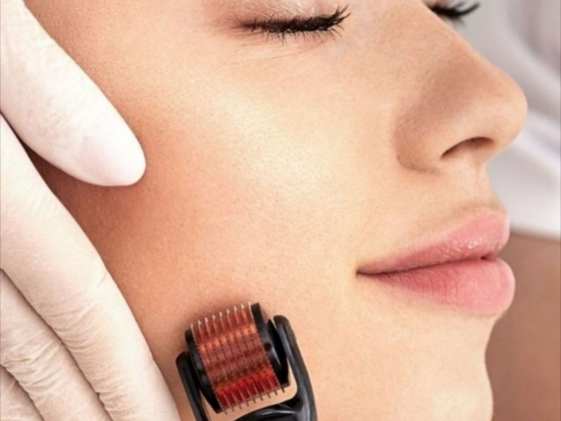 Dermaroller Treatment for Clear & Smooth Skin