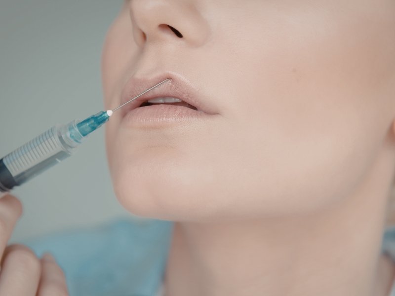 Lip Fillers in Defence Colony for Natural Looking Lips