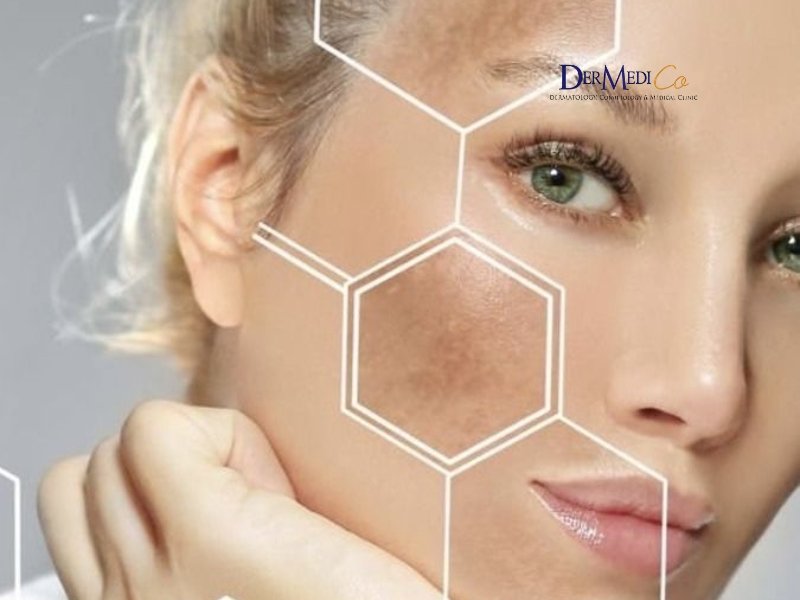 pigmentation treatment in defence colony delhi for dark spots and melasma