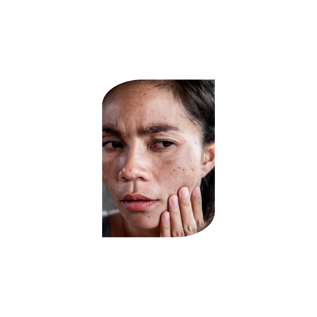 Best Dermatologist in Lajpat Nagar | Acne & Skin Treatment Expert