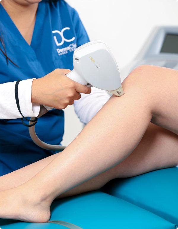 laser hair removal